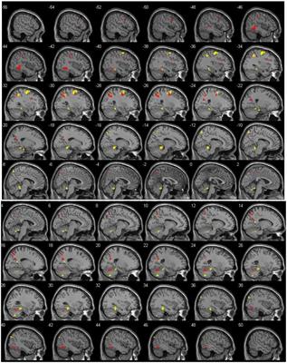 Neuroanatomic Correlates of Distance and Direction Processing During Cognitive Map Retrieval